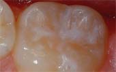 Sealant-After - Pediatric Dentist & Orthodontics in Garland, TX